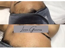 ラリマ グラマラス(Larima Glamorous)/脱毛