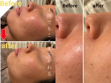 サロンソワ(salon Soi.)/SHIYAKAハーブピーリング