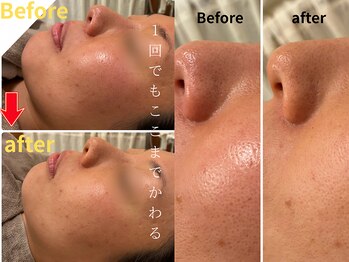 サロンソワ(salon Soi.)/SHIYAKAハーブピーリング