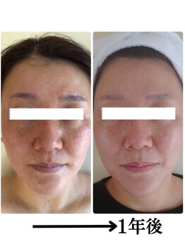 エステサロン ’Olu ’Oluの写真/肌質改善で憧れの陶器肌へ!徹底ケアで毛穴・くすみも一掃。完全個室で叶える本気の美肌体験