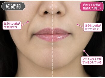 美光星の写真/小顔ケア＆頭皮ケアを同時に叶える贅沢トリートメント♪【フェイスアップ スカルプトリートメント￥11,000】