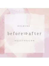 ベルミナ(Belmina)/大名/天神/毛穴/脱毛/痩身