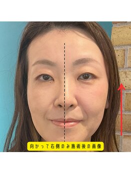 ネクスフィット(Nexfit)/小顔矯正フェイスリフトの効果