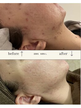 モア トゥインクル 倉敷店(MORE twinkle)/人気No.1！コラーゲンお顔脱毛♪