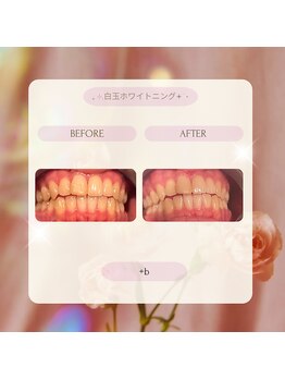 プラスビーセルフ(+b self)/ホワイトニングビフォーアフター