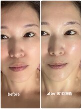 エクラ 六本木(eclat)/光FA×ニードレスインジェクター