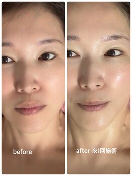 エクラ 六本木(eclat)/光FA×ニードレスインジェクター