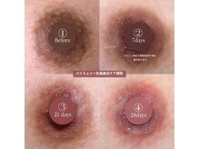 モア(more.)/黒ずみケア一回の変化