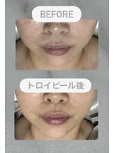シュクル(sucre)/50代女性 / before after 