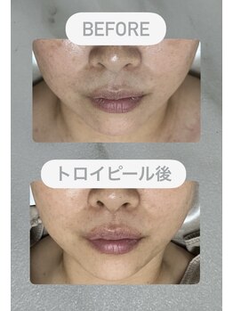 シュクル(sucre)/50代女性 / before after