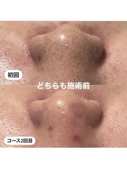 ミラーヴ(MERAVE)/men'sの毛穴変化/毛穴/毛穴洗浄