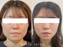 ミエル(mielu)/mielu式小顔矯正