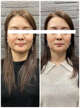 長寿鍼灸院 長寿整骨院/美容鍼50本の効果★小顔効果