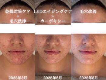 アールエーサロン 恵比寿 広尾(Ra salon)/半年のお肌の変化