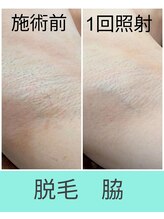 エミナル(EMINAL)/脇脱毛の効果！脱毛/毛穴/脱毛機