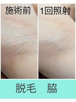 エミナル(EMINAL)/脇脱毛の効果!脱毛/毛穴/脱毛機