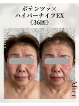 ネイルアンドアンチエイジングドゥシール(Docile)/70代女性｜小顔矯正・たるみ改善