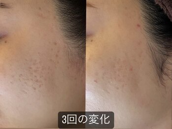 リードスラッシュ(LEAD/)/プロセルセラピーズお顔