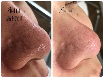 シェミー(CHEZ MEE)/【メンズ美容】黒ずみ/皮脂/赤み