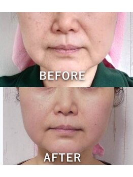 ココカラ(COCOKARA)/5Dラジオ波★リフトアップ