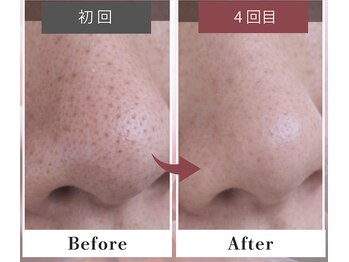 フルリール/【超音波毛穴洗浄＆全顔脱毛】