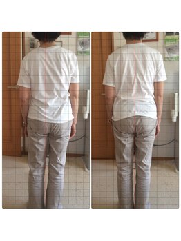 カイロプラクティック マーサン/ビフォーアフター