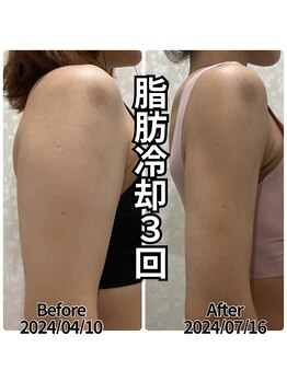 ディオーネ(Dione)/たったの3ヶ月で別人の腕♪