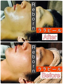リボーンラボ(ReBorn Lab)/メンズララピール+特許マスク
