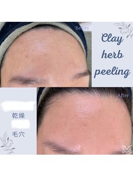 スリジエ ボーテ(cerisierBEAUTE)/額の横ジワ,赤ニキビケア!!