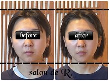 サロン ド アール(salon de R.)/【小顔骨氣・20代・施術効果】