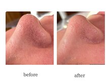 エム(emu)/小鼻ケア