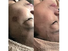 グレースフル 天文館店/シミケア専門店