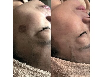 グレースフル 天文館店/シミケア専門店