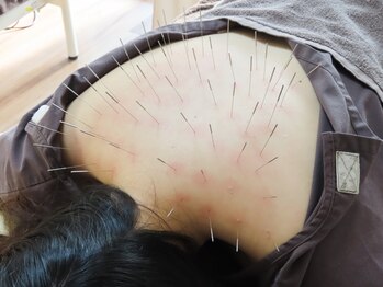 葵の葉鍼灸院の写真/鍼を多数本使用した【ルート施術】であなたのお身体のお悩みを根本から改善を目指します◎