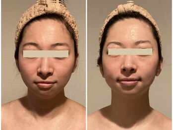 TKC 東京小顔センター五反田店の写真/短期集中で小顔に！［TKC小顔矯正」でゆがみ、左右差改善、首長小顔へ！挙式、ブライダルフォトにおすすめ