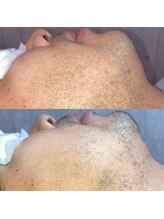 メンズ脱毛 リボーン(reborn)/何回照射したとおもいますか？