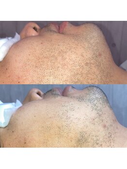 メンズ脱毛 リボーン(reborn)/何回照射したとおもいますか？