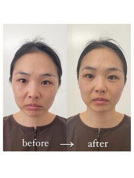 鍼グリッター 岡山本院(鍼Glitter.)/オリジナルメソッドの美容鍼☆