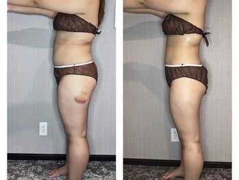 ブリス(bliss)/ウィンバック痩身効果！