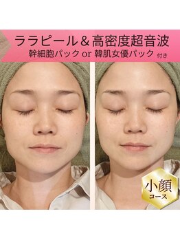 リムビューティー 自由が丘(RymBeauty)の写真/麻布十番の実績店が自由が丘へ！【期間限定キャンペーン】水光リフト+ララピール+幹細胞パックで最短小顔
