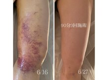 ナタリー(Natalie)/術後、内出血、むくみケア