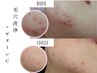 【黒毛穴×ニキビ】全顔毛穴洗浄+スーパービタミンC導入+保湿