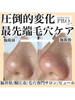 ピュール 鯖江店(PUR)/毛穴/毛穴ケア/毛穴洗浄