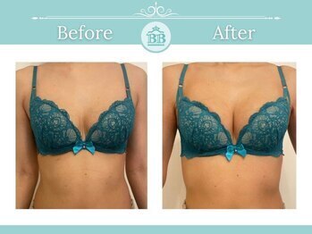 美人バスト 新潟店/ 【バストアップ★育乳】症例