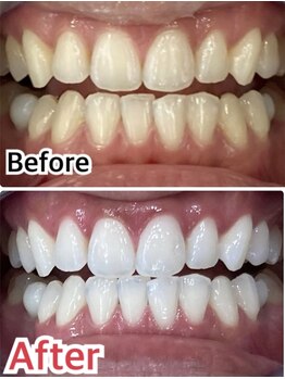 ホワイトニングスタイル 柏店/芸能人レベルの白さも叶う★