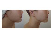 りた/法令線・たるみ改善