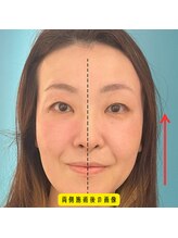 ネクスフィット(Nexfit)/小顔矯正フェイスリフトの効果