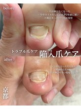 アイル(isle)/【陥入爪にお悩み】のお客様