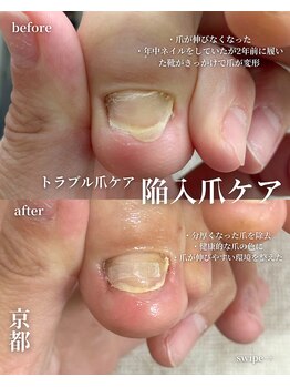 アイル(isle)/【陥入爪にお悩み】のお客様