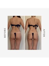 ラグレ(LUXRE)/脂肪冷却モニター（30代）